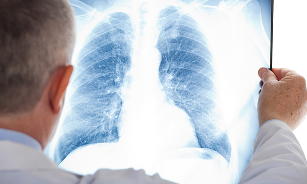 Antioxydants et risque de cancer du poumon