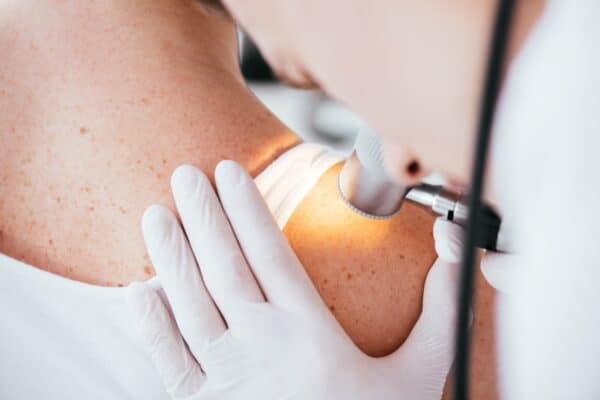 An “intelligent tattoo” to detect skin cancer before it appears 